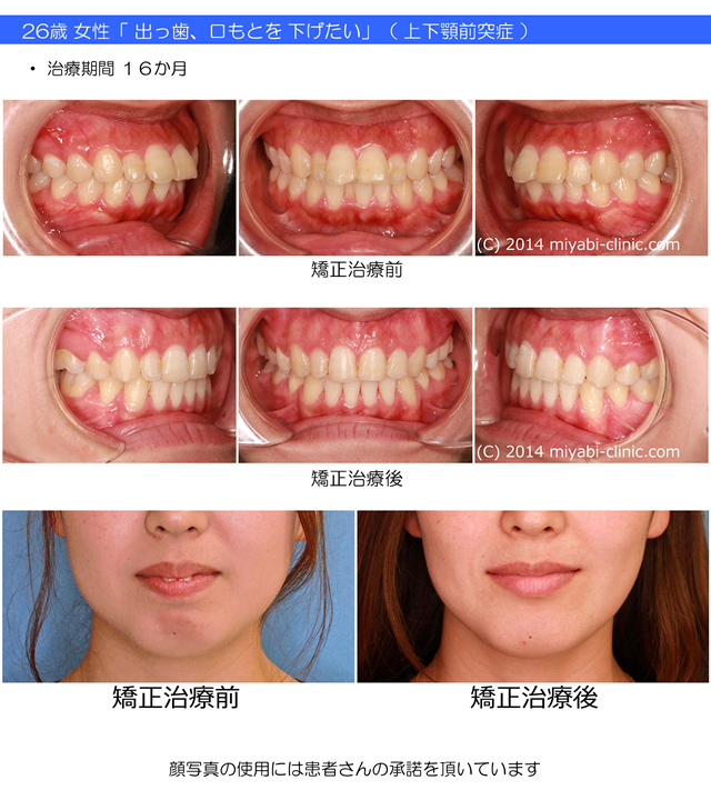 症例の一覧 気づかれない目立たない矯正 みやび矯正歯科医院 岡山 倉敷 インビザライン みやび矯正歯科医院