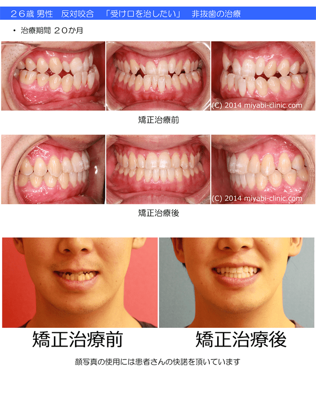 症例の一覧 気づかれない目立たない矯正 みやび矯正歯科医院 岡山 倉敷 インビザライン みやび矯正歯科医院
