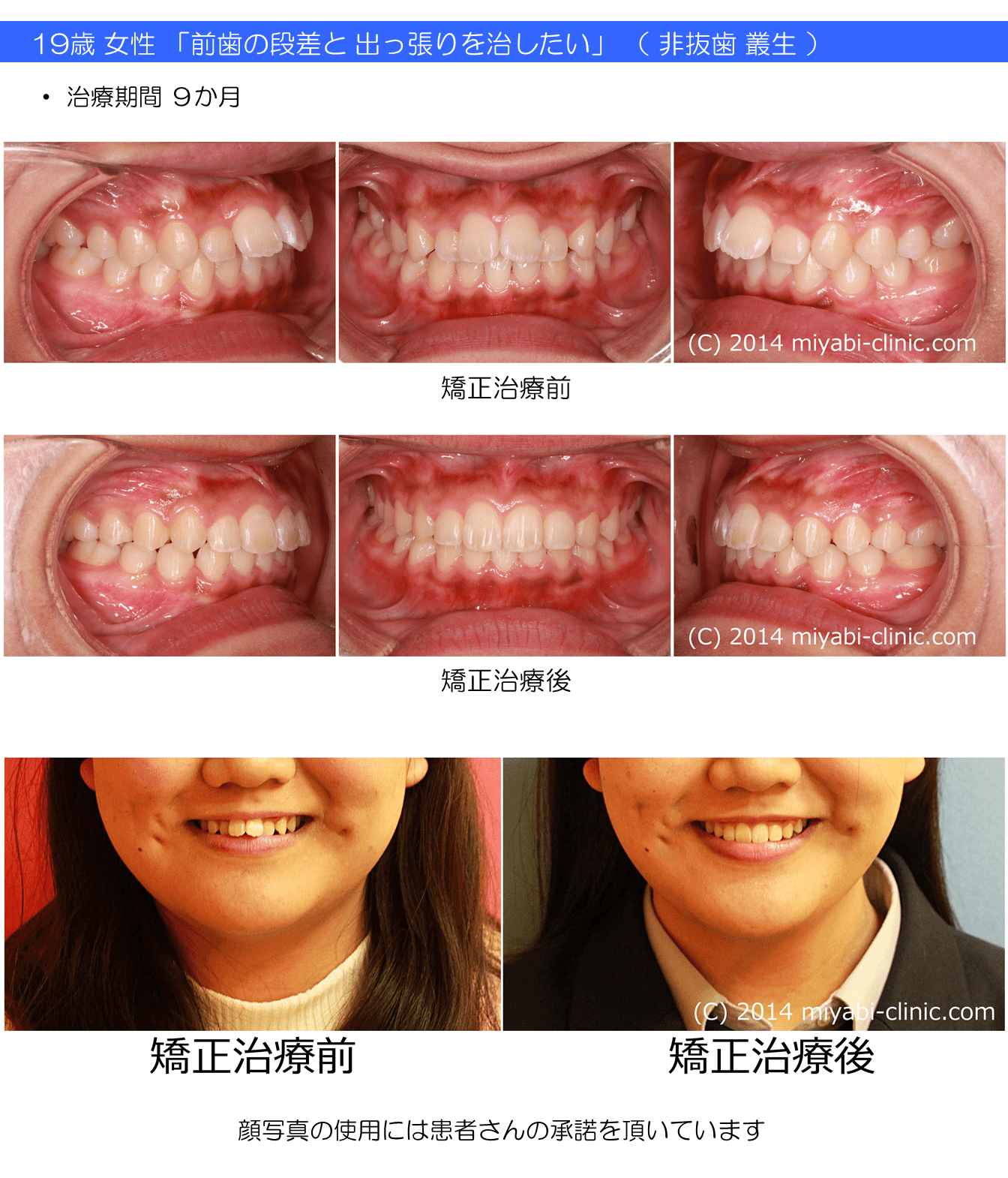症例の一覧 気づかれない目立たない矯正 みやび矯正歯科医院 岡山 倉敷 インビザライン みやび矯正歯科医院