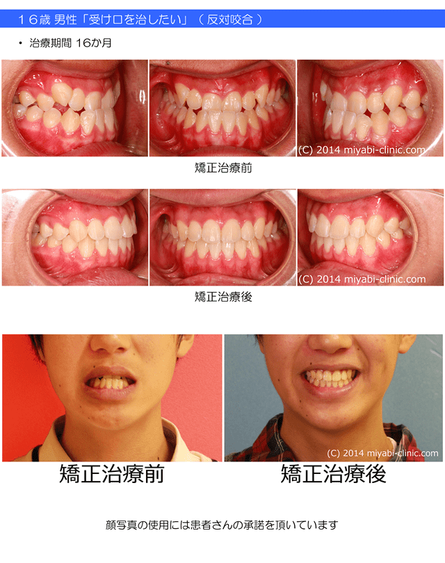 症例の一覧 気づかれない目立たない矯正 みやび矯正歯科医院 岡山 倉敷 インビザライン みやび矯正歯科医院