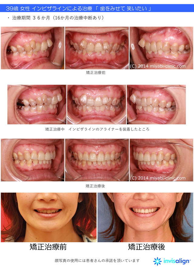 インビザラインってどうなの？ - 気づかれない目立たない矯正／みやび矯正歯科医院 - 岡山／倉敷／インビザライン | みやび矯正歯科医院