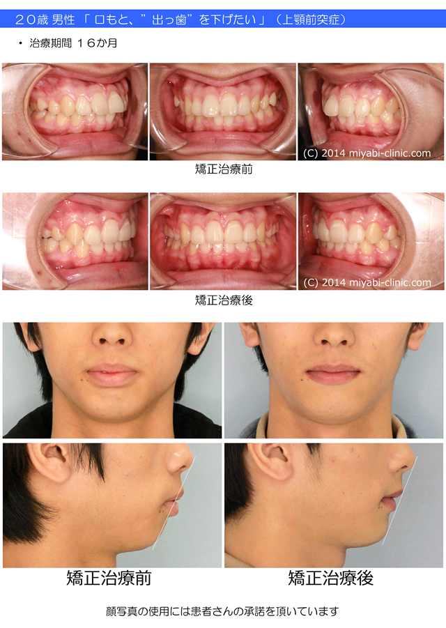 症例の一覧 - 気づかれない目立たない矯正／みやび矯正歯科医院 - 岡山 