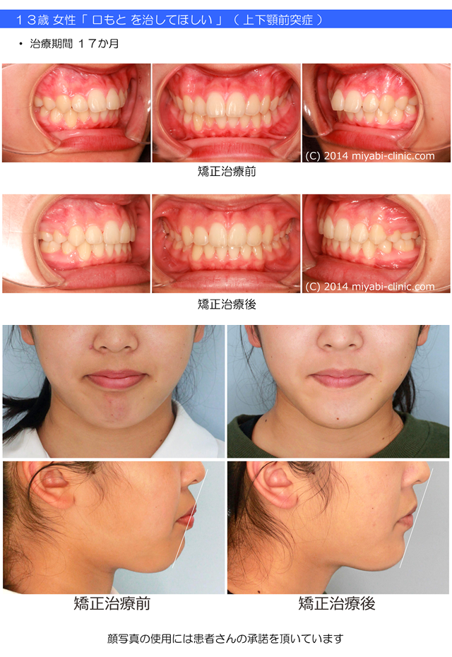 症例の一覧 - 気づかれない目立たない矯正／みやび矯正歯科医院 - 岡山 