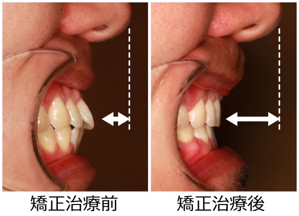 口ゴボ治療前後