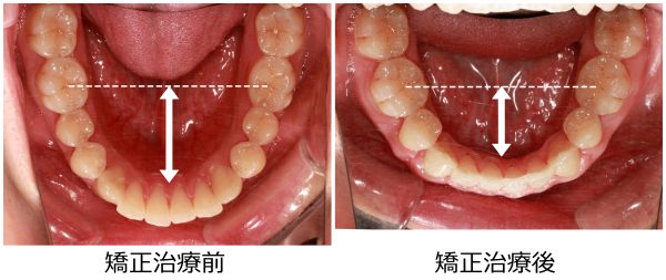 口ゴボ治療前後