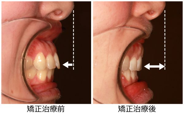 口ゴボ治療前後