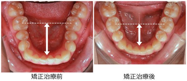 口ゴボ治療前後