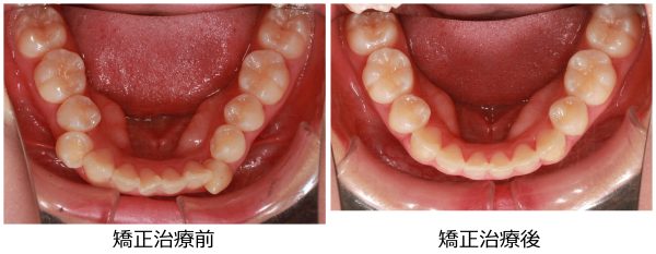 八重歯治療前後