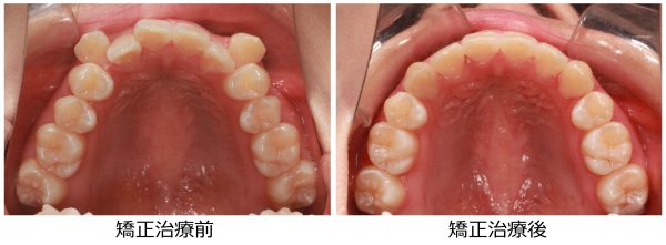 八重歯治療前後